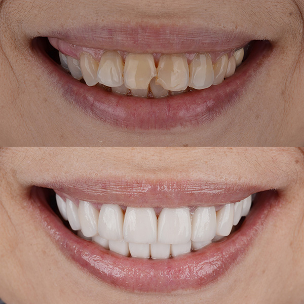 Complete smile makeover from darken teeth and crooked teeth to white and well aligned smile.